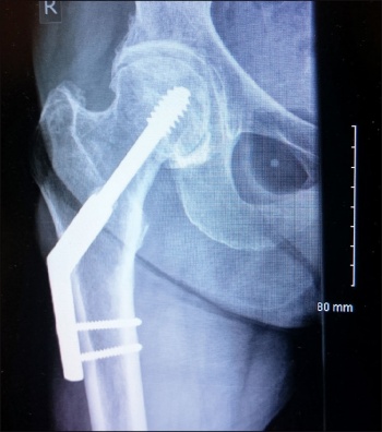Figure 1. DHS two-hold plate for neck of femur fracture