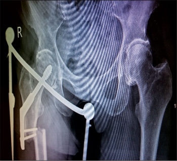 Sub-trochanteric femur shaft fracture