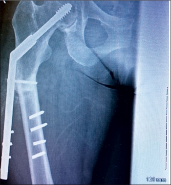 Figure 4. Peri-prosthetic fracture