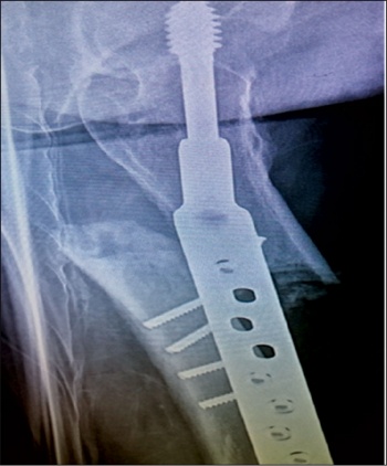Figure 5. Lateral view of peri-prosthetic fracture