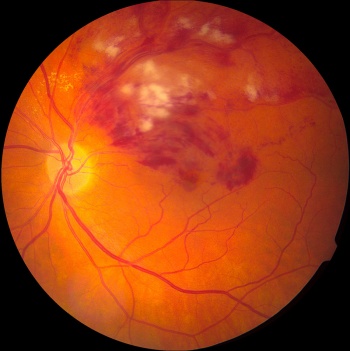 Figure 1. Left supero-temporal branch retinal vein occlusion, showing significant haemorrhage and extensive cotton-wool spots (retinal nerve fibre layer infarction)