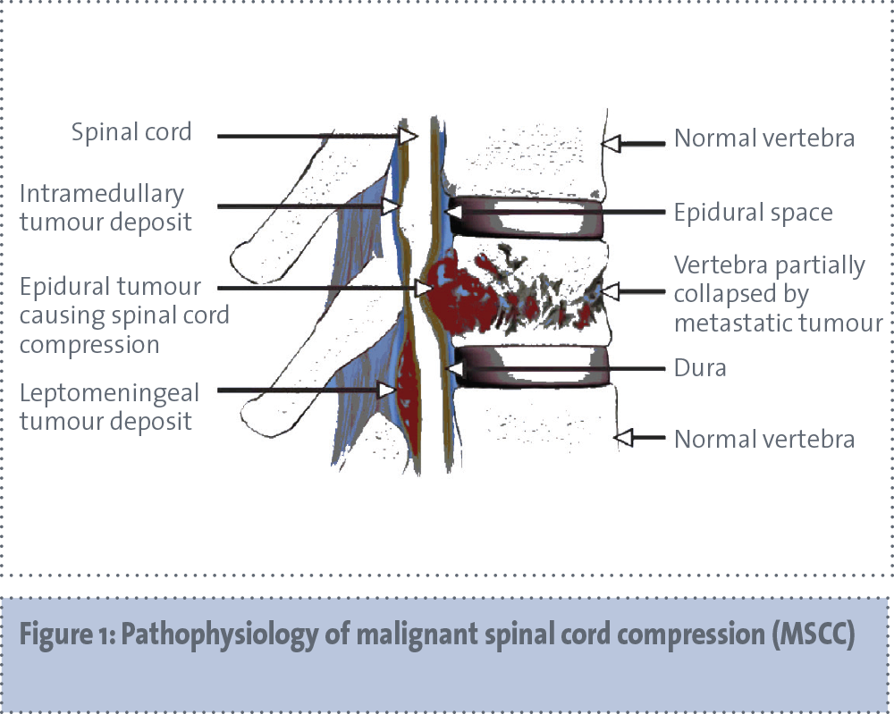 Management of malignant spinal cord compression