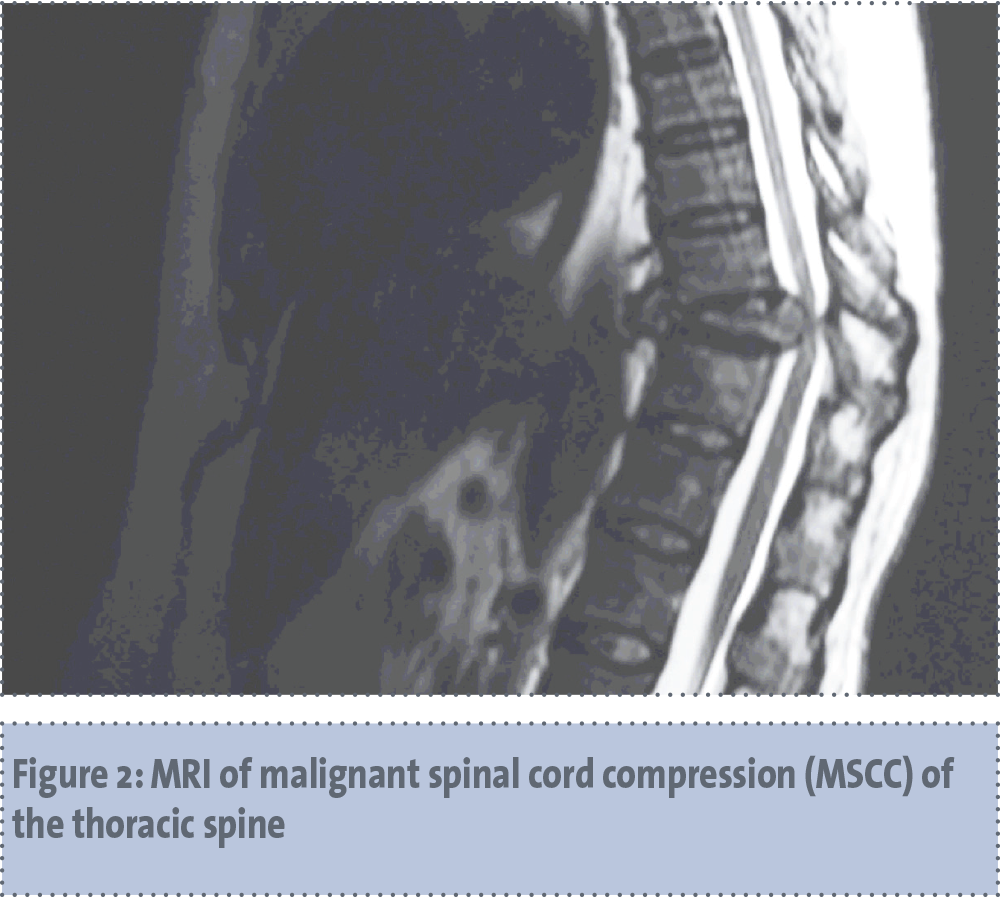 Management of malignant spinal cord compression