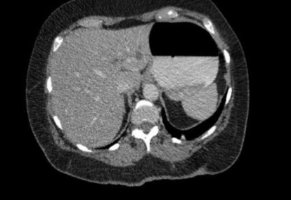 Figure 2. CT abdomen showing pulmonary, bony and hepatic metastases