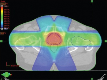 Figure 1. An axial slice through a standard 3D conformal CT plan delivering radical radiotherapy for prostate cancer. The highest doses are represented in red (seen encircling the targeted prostate) and the lowest in blue