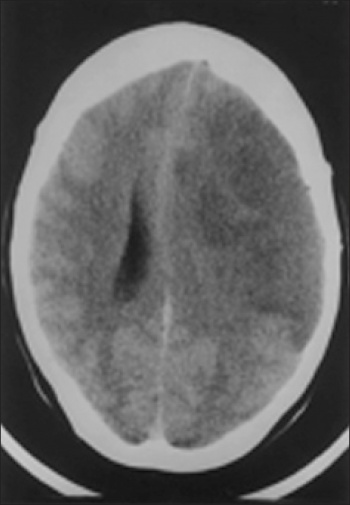 Figure 1: Left MCA infarction with cerebral oedema and midline shift
