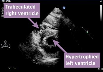 Figure 1: ECHO image of the patient's heart