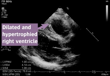 Figure 2: ECHO image of the patient's heart