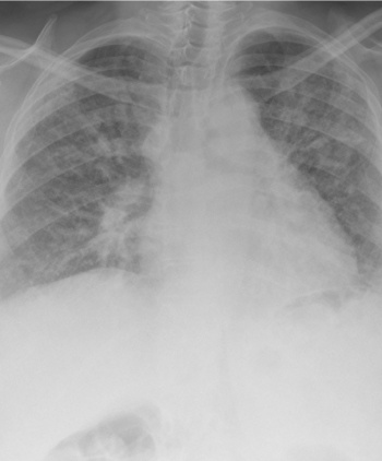 Severe pulmonary fibrosis