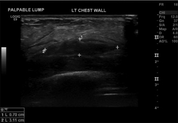 Figure 1: Ultrasound of anterior chest wall – hypoechoic complex fluid collection in the left chest wall