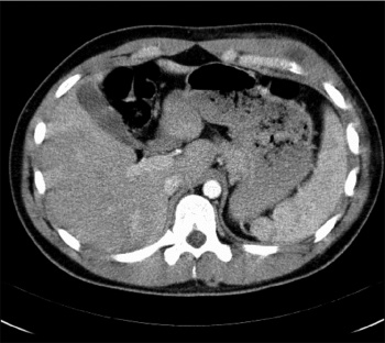 Figure 2: CT thorax – low attenuating lesion in overlying anterior ribs/costochondral areas 5 to 7 with associated intercostal muscle thickening