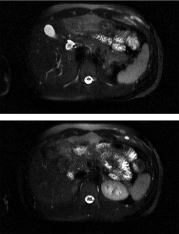Figure 3: MRI post contrast – small intramuscular fluid collection that demonstrates rim enhancement. There is diffuse periosteal enhancement of the sixth rib. The appearance is suggestive of infectious process with an intramuscular abscess and associated osteomyelitis anterior rib