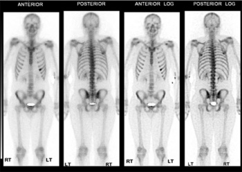 Figure 4: Nuclear imaging of whole body scan – radioisotope uptake of the sixth rip on anterior view