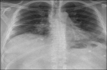 Figure 1. Bilateral lymphadenopathy with left basal infiltrate