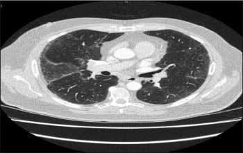 Figure 2. Bilateral ground glass opacities