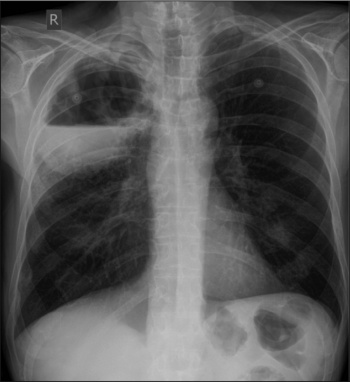 Figure 1. Chest x-ray showing a large cavitating lesion in the right upper lobe