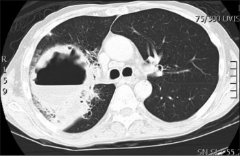 Figure 2. A CT chest with contrast showed a 13x10x12cm cavitating lesion predominantly in the right upper lobe