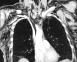 Figure 3. CT scan showing subcutaneous emphysema