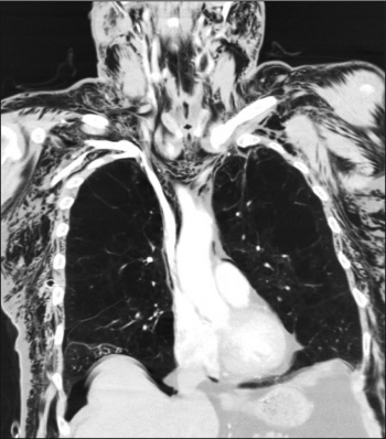 Figure 3. CT scan showing subcutaneous emphysema