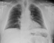 Figure 1. X-ray chest – no evident rib fracture