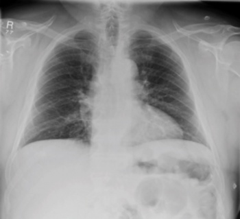 Figure 1. X-ray chest – no evident rib fracture