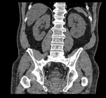 Figure 2. CT image showed left 10th rib fracture, (arrow mark)