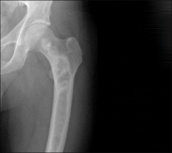 Figure 1. Radiographic findings on fibrous dysplasia in the femur