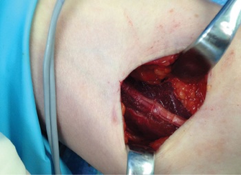 Figure 1. The ulnar nerve had a normal macroscopic appearance and was surrounded with rather unimpressive localised haematoma and muscle bruising, supporting a diagnosis of ulnar nerve neuropraxia