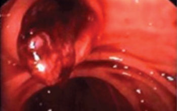 Figure 1. Blood coming from ampulla of Vater at upper GI endoscopy  