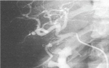 Figure 2. Blood within the biliary ducts  