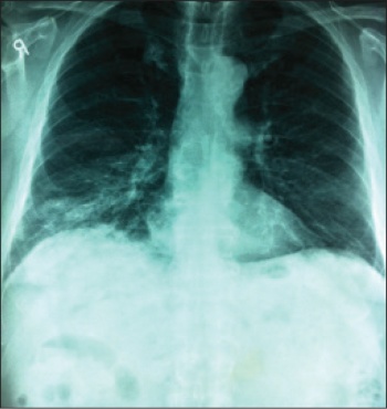 Figure 1. Initial CXR on presentation