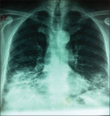 Figure 2. Repeat CXR one week later