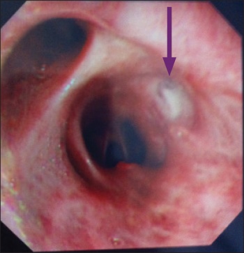 Figure 3. Initial bronchoscopy that revealed lesion (arrowed) which was shown to be incidental finding with a benign histology