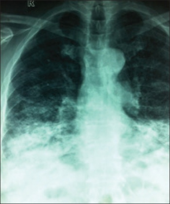 Figure 4. CXR three weeks later showing extensive bi-basal involvement 