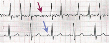 Figure 1: There are no distinct P-waves evident, some irregular activity may be seen