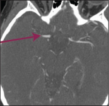 Figure 1 (i): this and Figure 1(ii) show axial and coronal CT angiogram identifying proximal right MCA (M1) occlusion