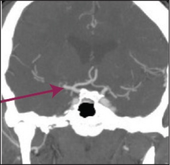 Figure 1(ii): this and Figure 1 (i) show axial and coronal CT angiogram identifying proximal right MCA (M1) occlusion