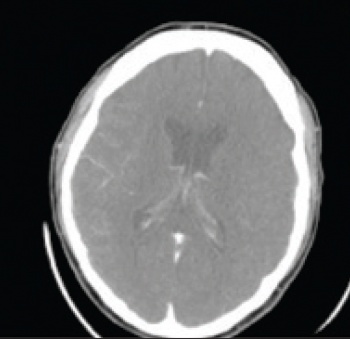 Figure 2(i): CT perfusion imaging demonstrating large mismatch in the right MCA territory: CT source image