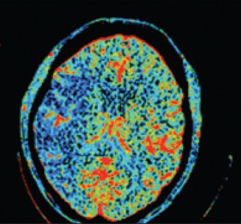 Figure 2(ii): CT perfusion imaging demonstrating large mismatch in the right MCA territory: decreased blood flow