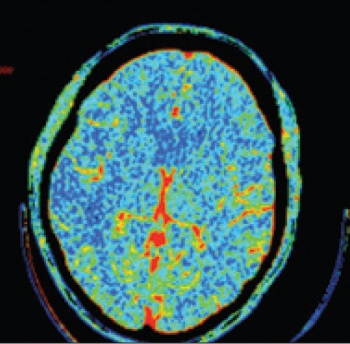 Figure 2(iii): CT perfusion imaging demonstrating large mismatch in the right MCA territory: increased mean transit time