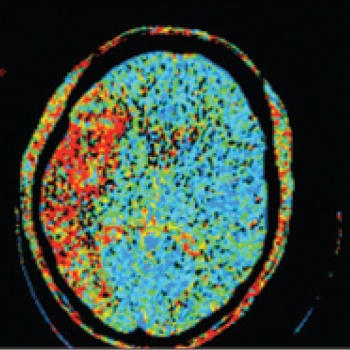 Figure 2(iv): CT perfusion imaging demonstrating large mismatch in the right MCA territory: preserved blood volume