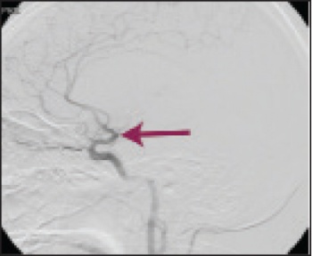 Figure 3 (i): Cerebral angiogram before recanalisation with the Penumbra device