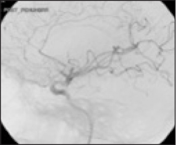 Figure 3 (ii): Cerebral angiogram after successful recanalisation with the Penumbra device