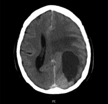 Figure 1: CT brain scan showing 6cm x 3cm mass lesion (partially cystic) in the left parietal and occipital lobes 