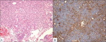 Figure 2: A. Haematoxylin and eosin-stained section showing solid area of tumour composed of microglandular adenocarcinoma (10x); 
B. Section immunostained with anti-prostatic specific antigen strong brown positivity in tumour cells and gland lumena (10x)