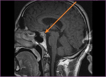 Figure 1: Pre-surgery, the first MRI, T1-weighted (sagittal) – the pituitary fossa shows a macroadenoma (11 mm)
