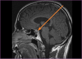 Figure 2: Second MRI T1-weighted (sagittal) – the pituitary fossa shows a macroadenoma. Pre-surgery, almost one year on cabergoline and no significant changes in the size of the macroadenoma