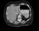 Figure 2. CT abdomen showing pulmonary, bony and hepatic metastases