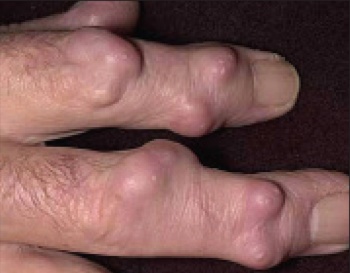 RA nodules of the hands secondary to inflammatory joint disease