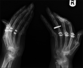 X-ray clearly showing joint replacements of the MCP joints secondary to deformities of inflammatory joint disease